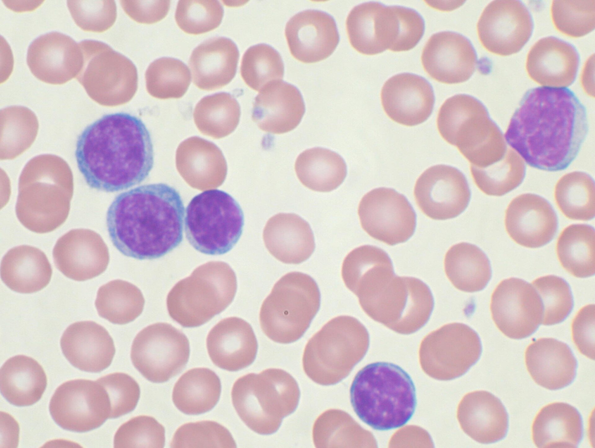 CLL smudge cells — source media 2