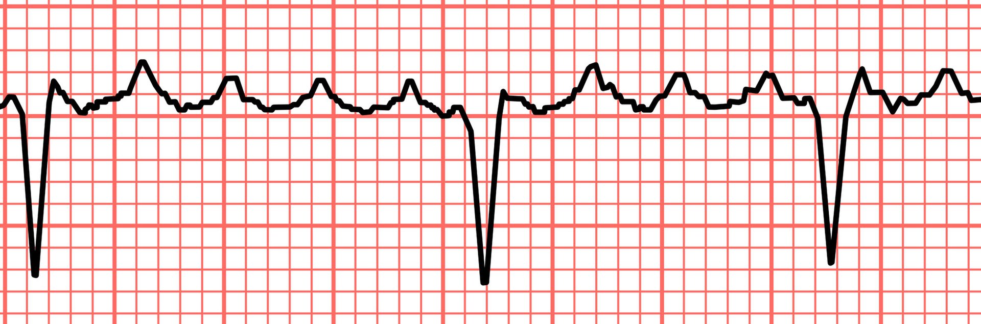 Atrial flutter — source media 3