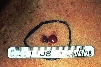 Melanoma skin — source media 2