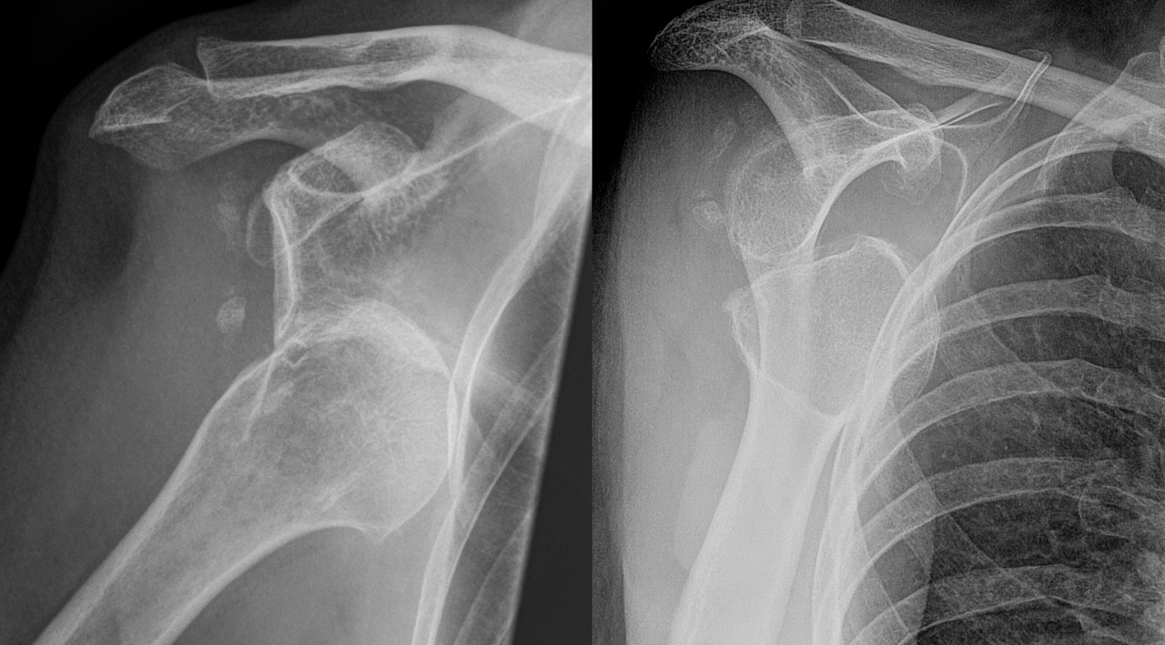 Anterior shoulder dislocation — source media 2
