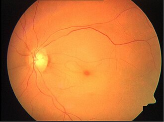 Central retinal artery occlusion — source media 3