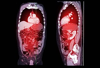 Acute appendicitis — source media 3