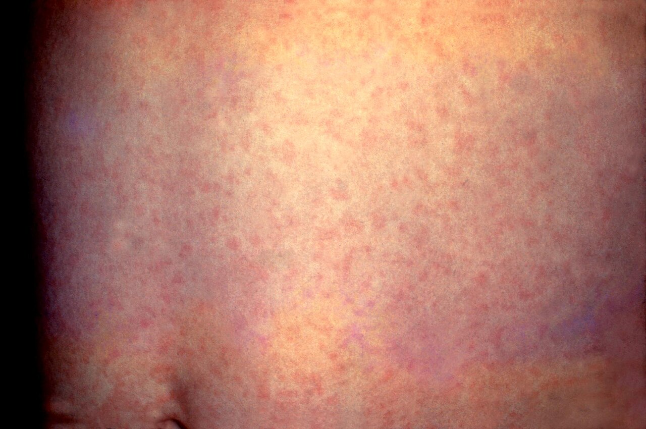 Rubella exanthem — source media 2