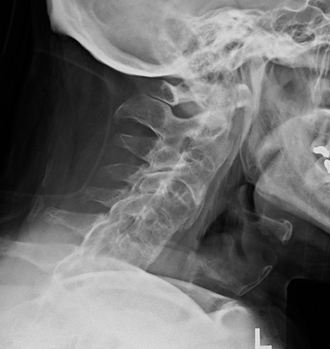 Ankylosing spondylitis — source media 2