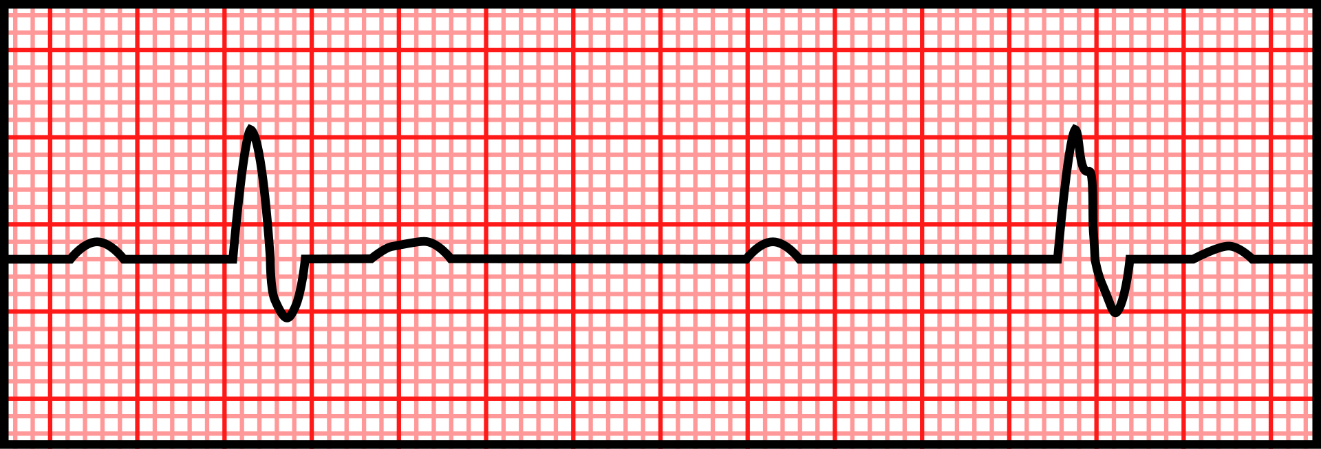 Complete heart block — source media 2