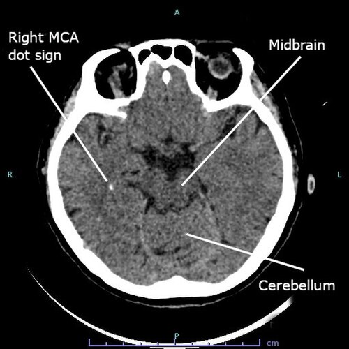 MCA stroke CT — source media 3