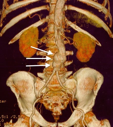 Abdominal aortic aneurysm — source media 3