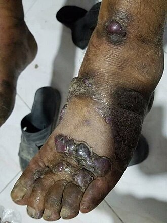 Kaposi sarcoma — source media 2