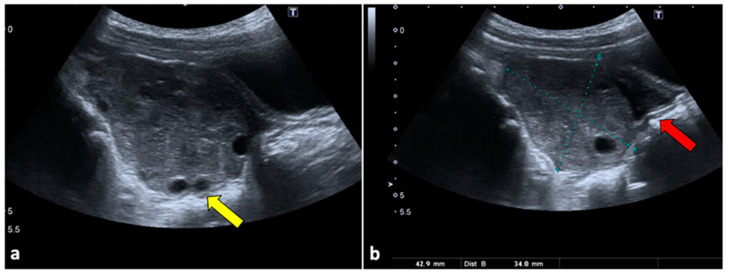 Enlarged ovary on gray-scale ultrasound — source media 2