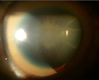 Kayser Fleischer ring — source media 3