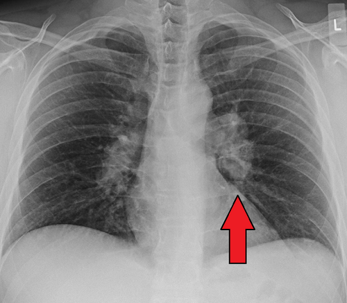 Sarcoidosis hilar adenopathy — source media 2
