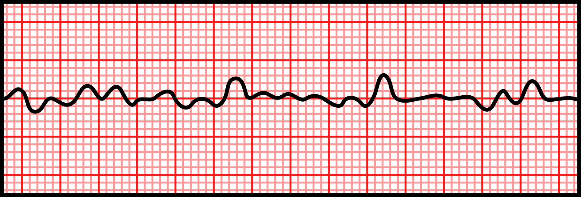 Ventricular fibrillation — source media 2
