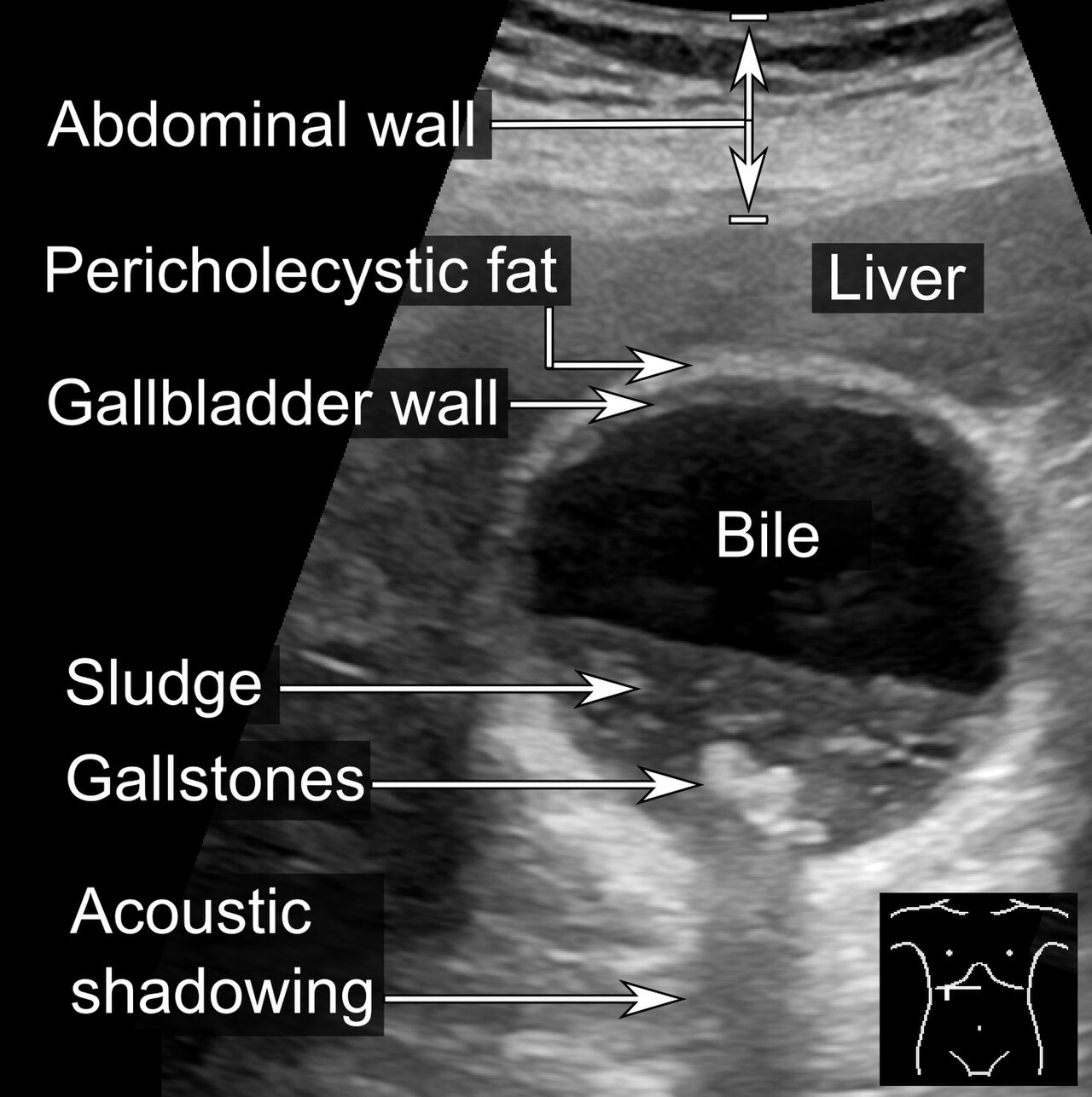 Acute cholecystitis ultrasound — source media 3