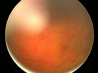 Papilledema fundus — source media 3