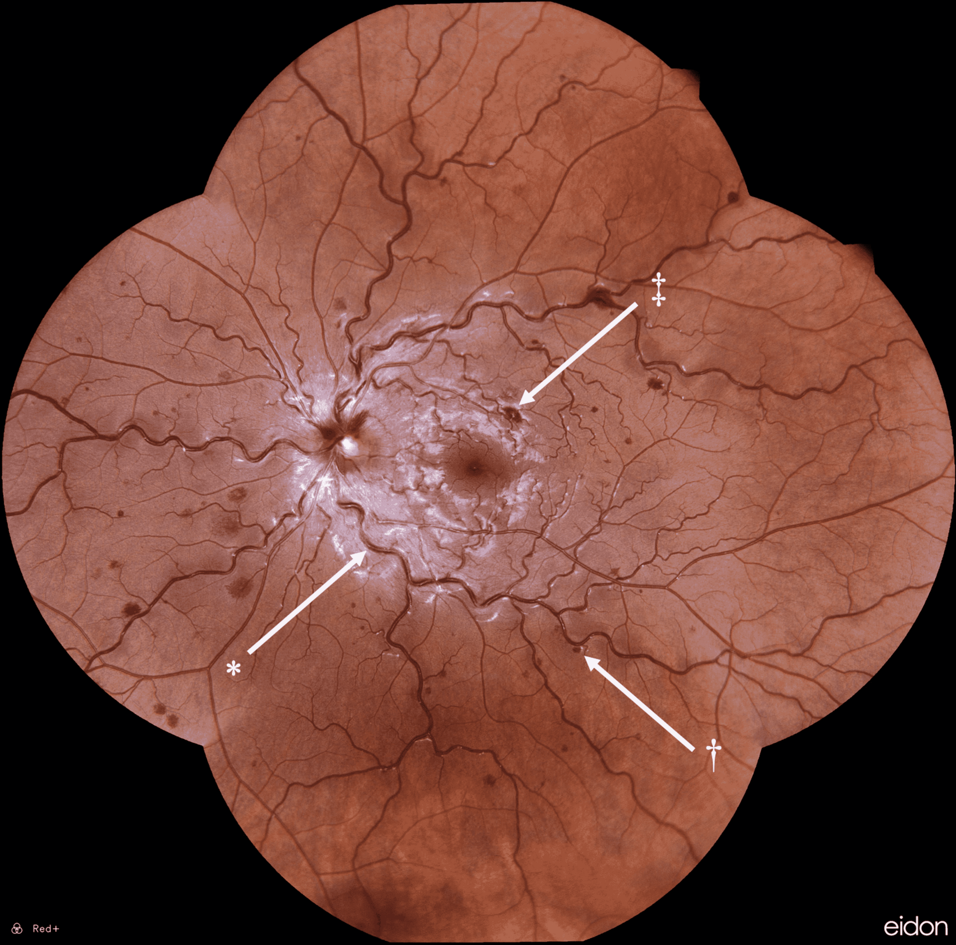Central retinal vein occlusion — source media 2