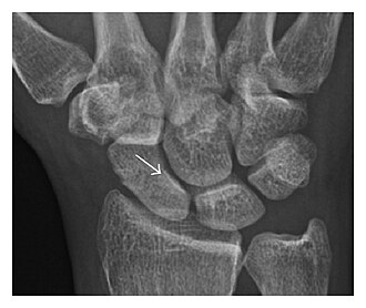 Scaphoid fracture — source media 3