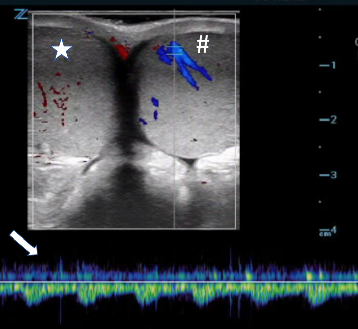 Absent right testicular flow versus left — source media 2
