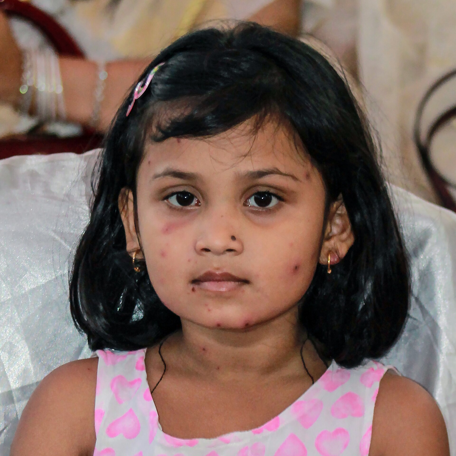 Varicella rash — source media 2