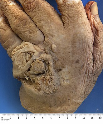 Squamous cell carcinoma — source media 2