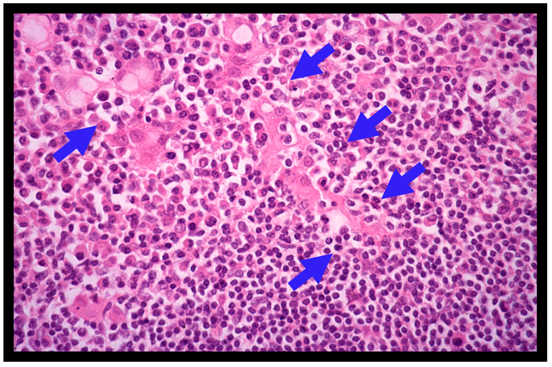 Gastric MALT lymphoma — lymphoepithelial lesions — source media 2