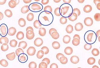 Schistocytes blood smear — source media 2