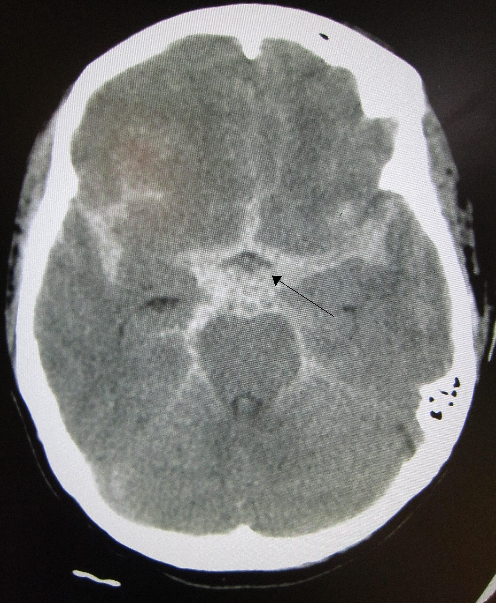 Subarachnoid hemorrhage CT — source media 2