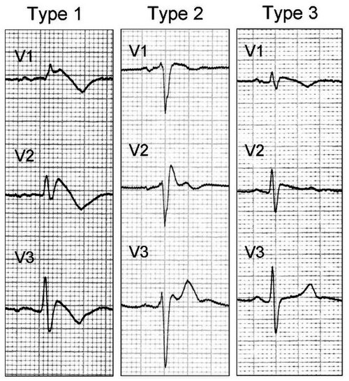 Brugada pattern — source media 3