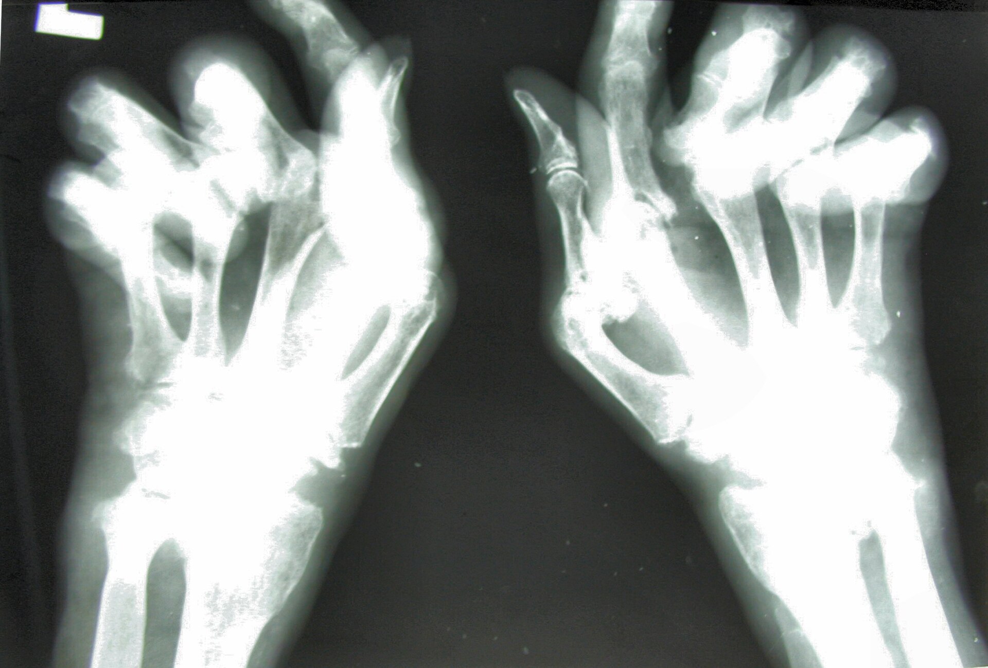Rheumatoid arthritis hand — source media 2