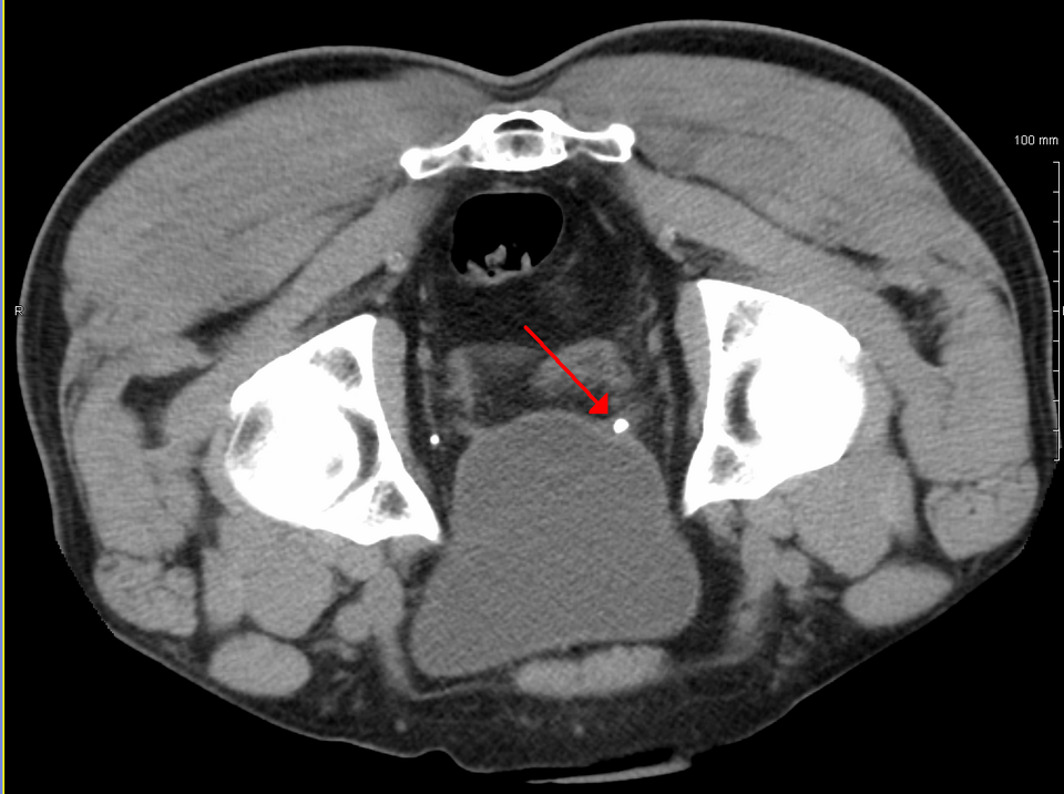 Ureteral stone CT — source media 2