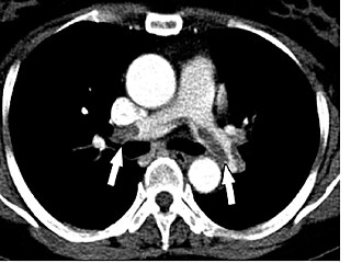 Pulmonary embolism — source media 3