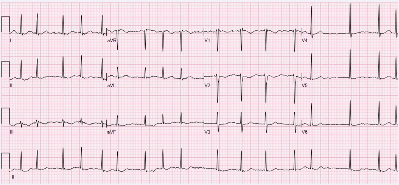 Atrial fibrillation — source media 3