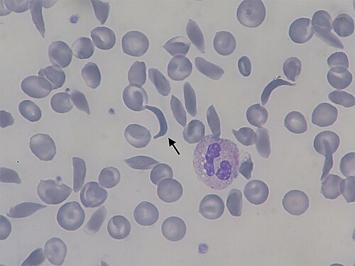 Sickle cell smear — source media 3