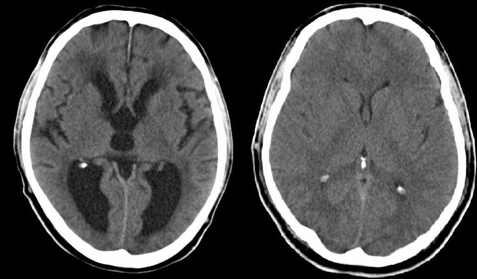 Hydrocephalus CT — source media 2