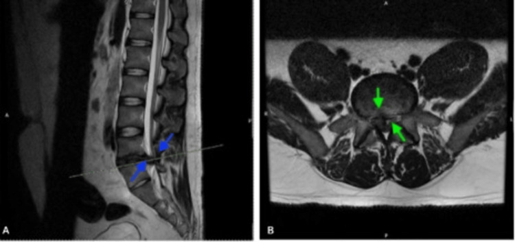 Cauda equina MRI — source media 3