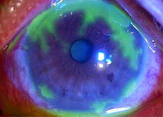 HSV dendritic keratitis — source media 2