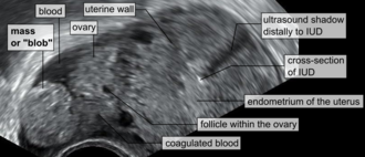 Ectopic pregnancy ultrasound — source media 2