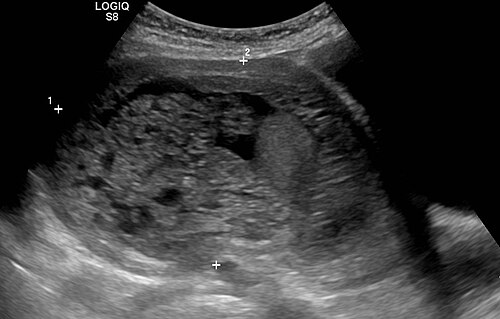 Hydatidiform mole ultrasound — source media 3