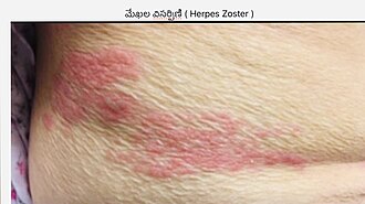 Herpes zoster — source media 3