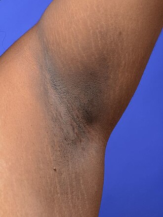 Acanthosis nigricans — source media 2