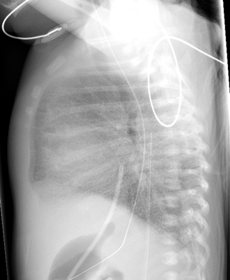 Neonatal respiratory distress — source media 3