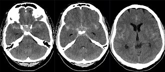 Subarachnoid hemorrhage CT — source media 4