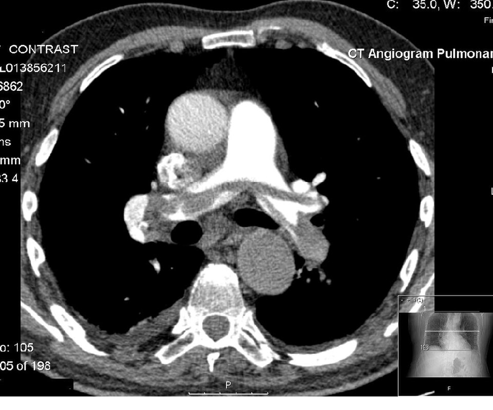 Pulmonary embolism — source media 2