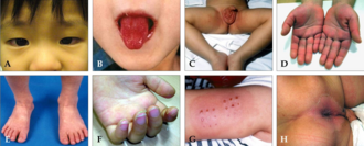 Kawasaki disease — source media 2