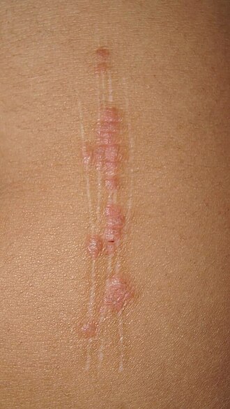 Plaque psoriasis — source media 3