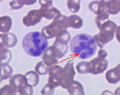 Megaloblastic anemia smear — source media 3
