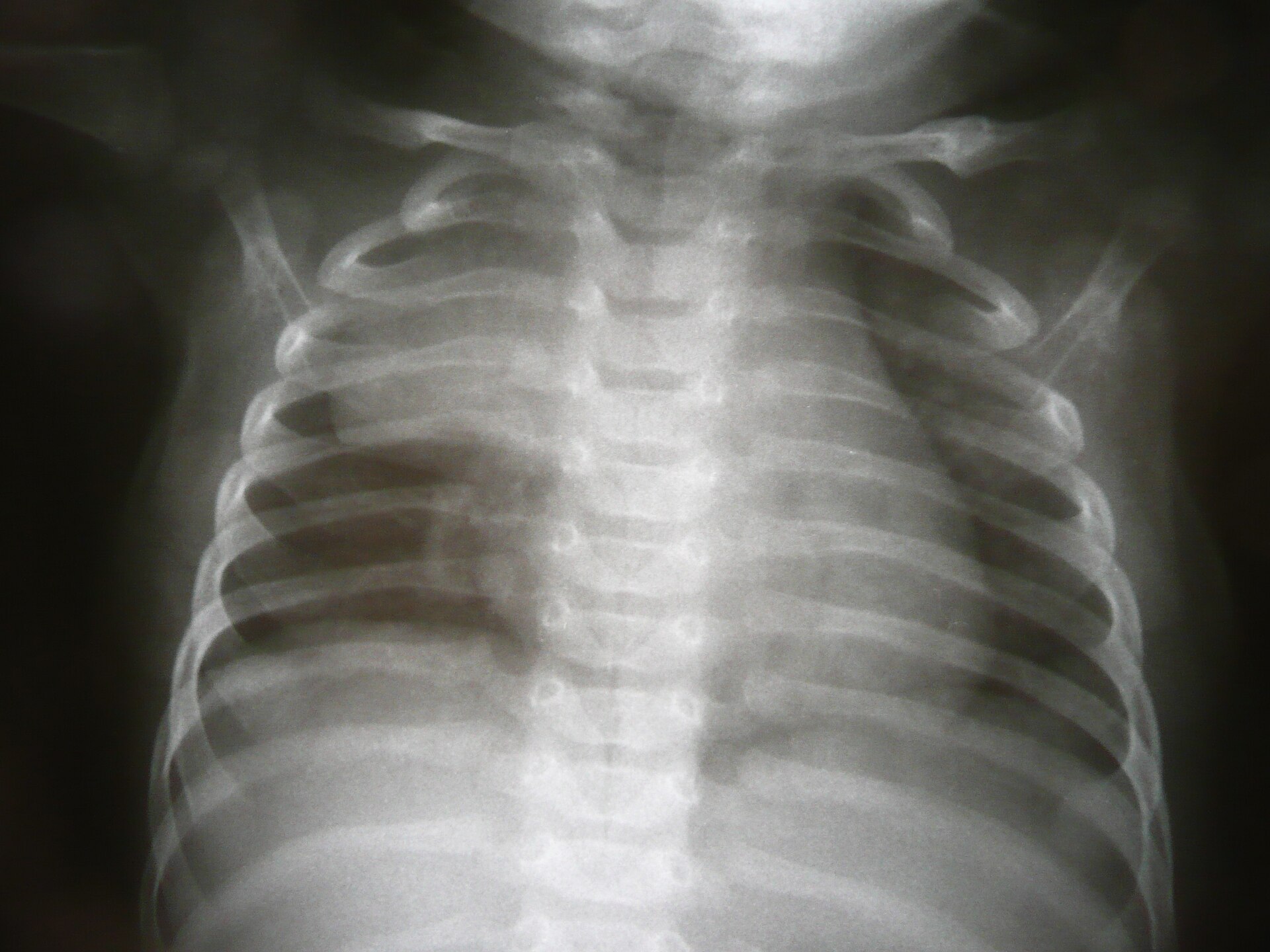 Absent thymic shadow — source media 2