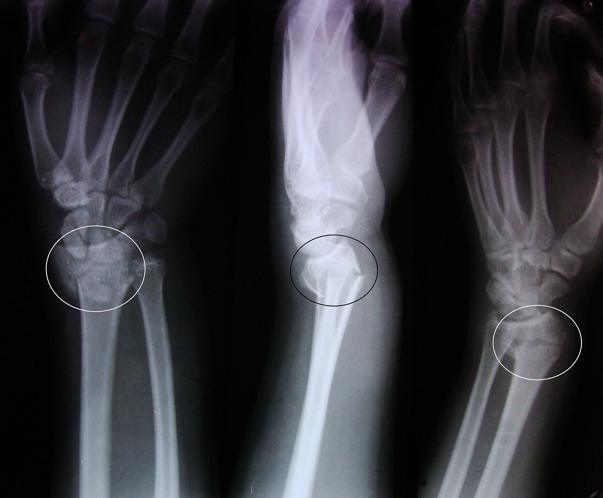 Colles fracture — source media 2