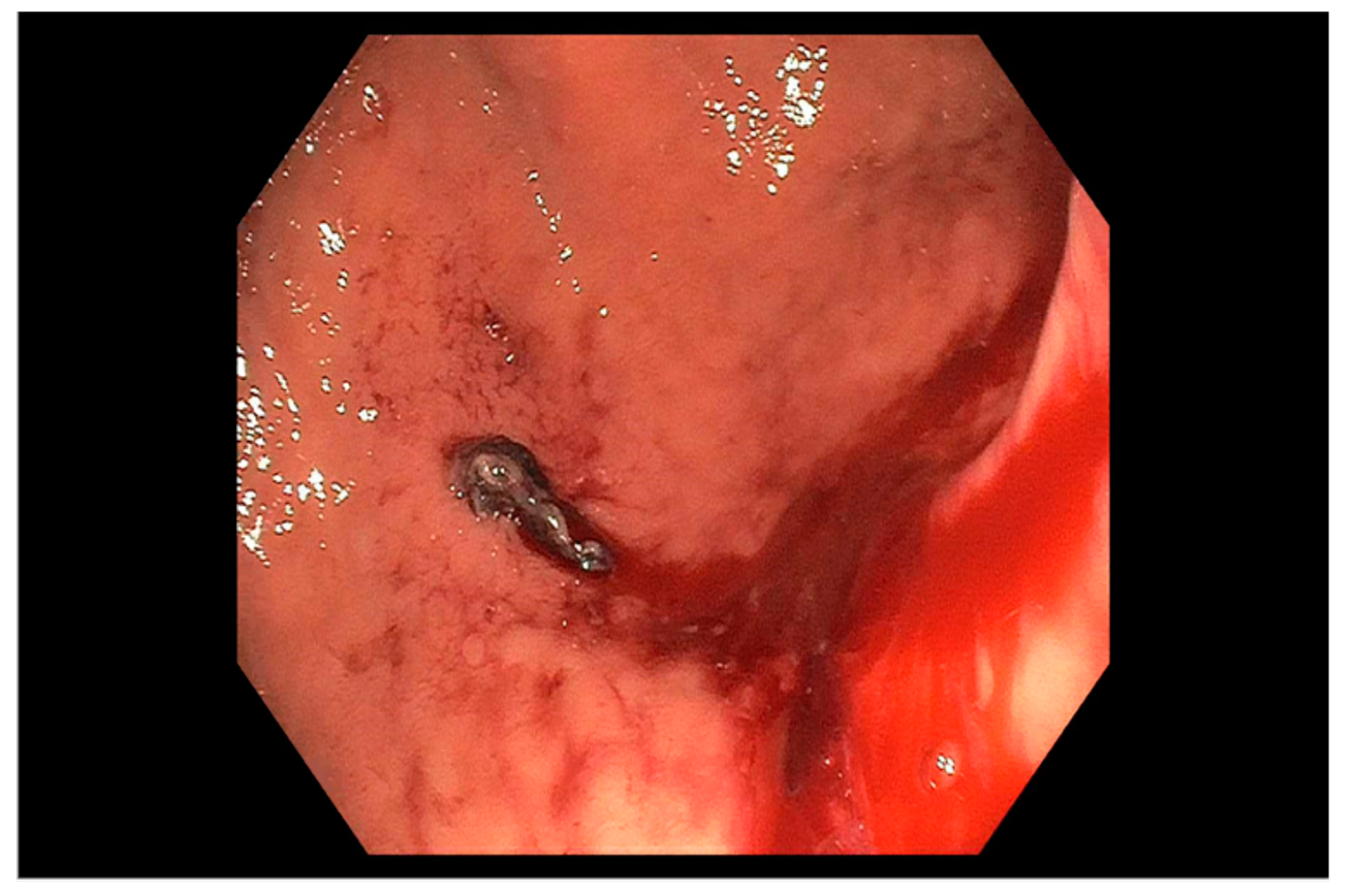 Bleeding peptic ulcers on endoscopy — source media 2