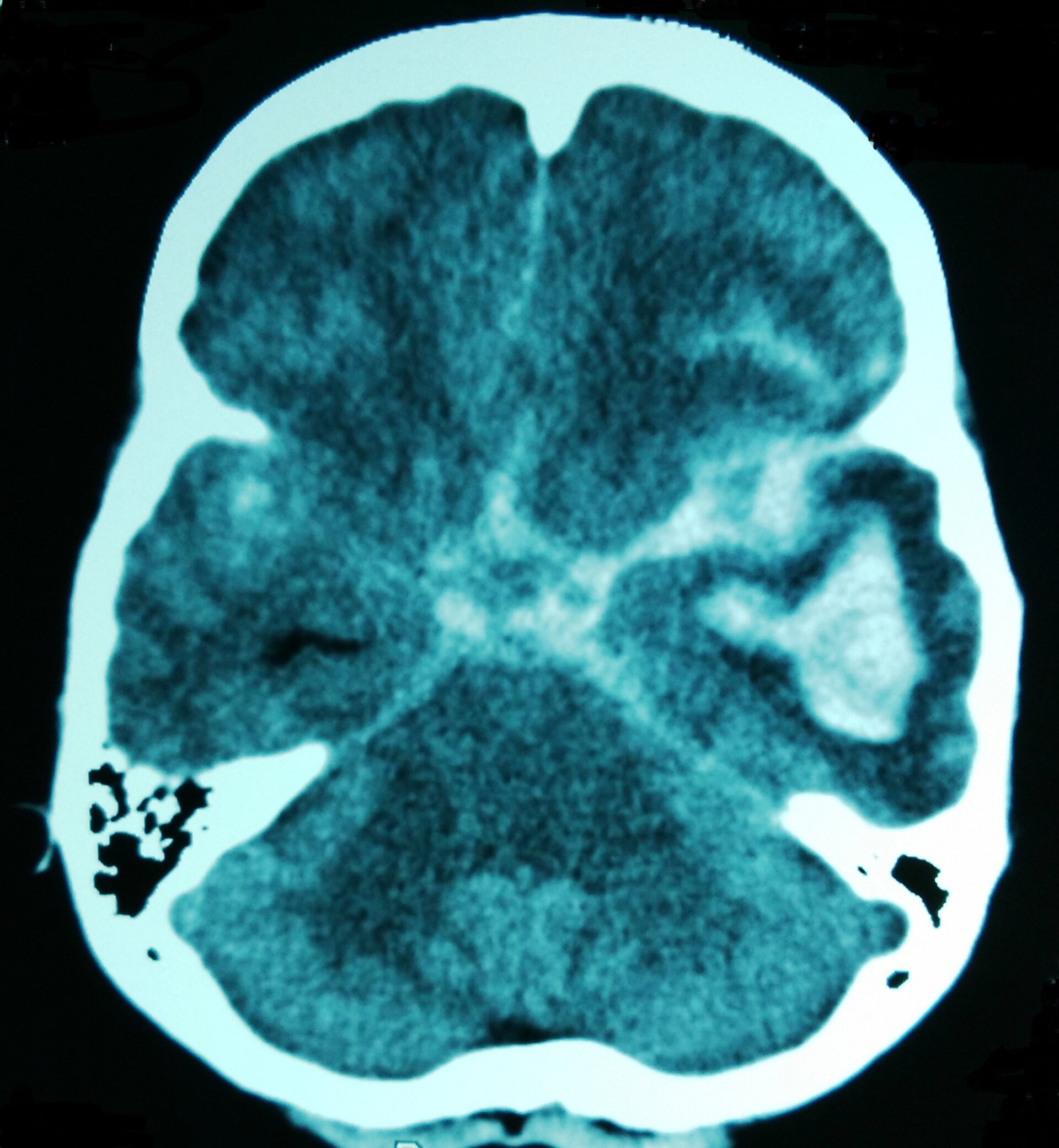 Subarachnoid hemorrhage CT — source media 3