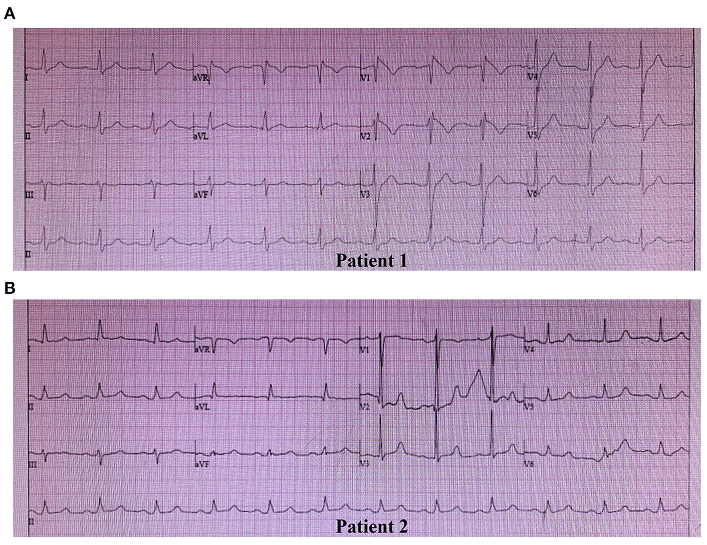 Brugada pattern — source media 2